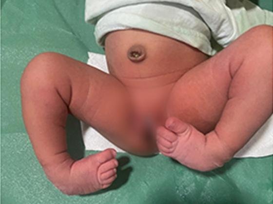 clubfoot-treatment-Hyderabad