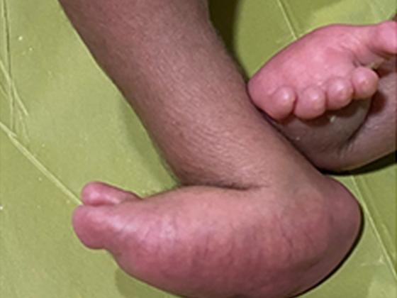 congenital-vertical-talus-treatment-Hyderabad