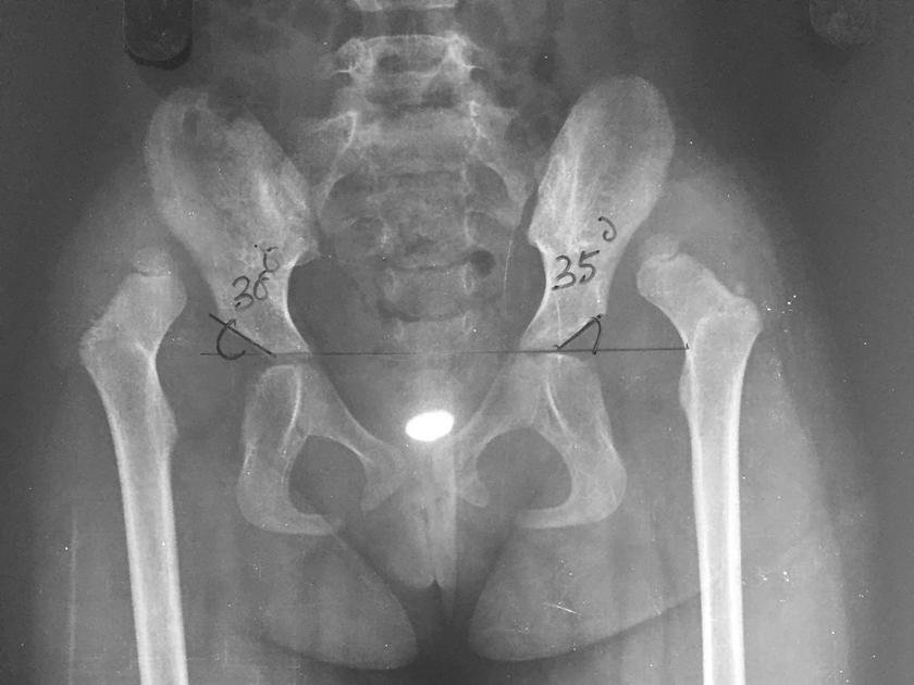 developmental-displacement-of-the-hip-treatment-Hyderabad