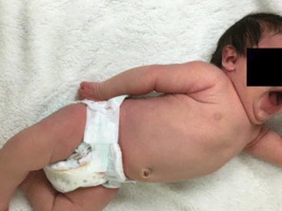 erb's-palsy-treatment-Hyderabad