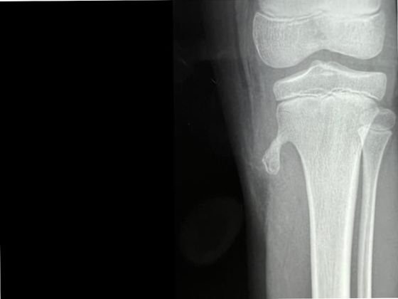 exostosis-treatment-Hyderabad