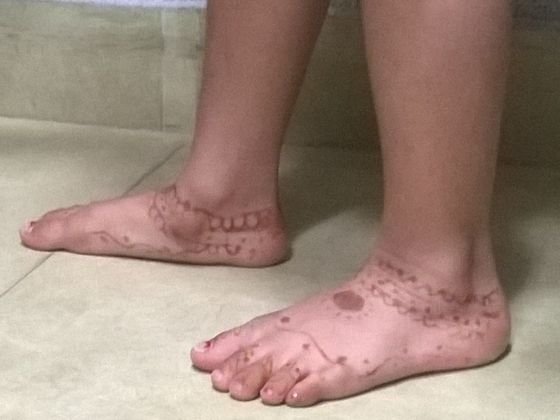 flatfoot-treatment-Hyderabad