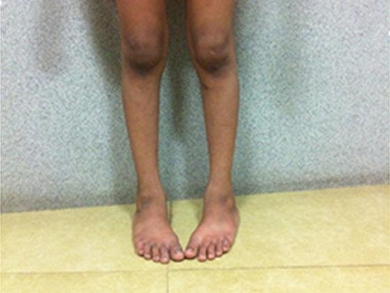 intoeing-treatment-Hyderabad 