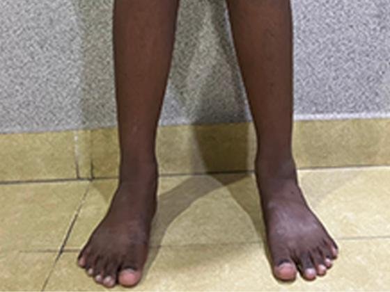 knock-knees-treatment-Hyderabad