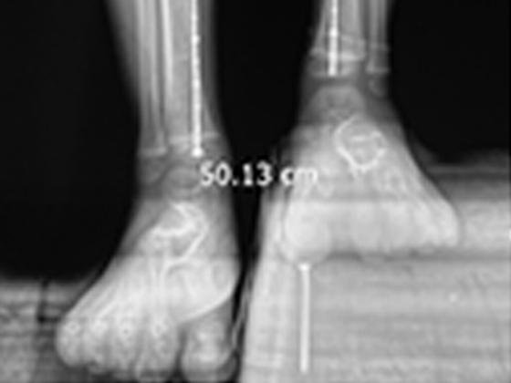 leg-length-correction-Hyderabad