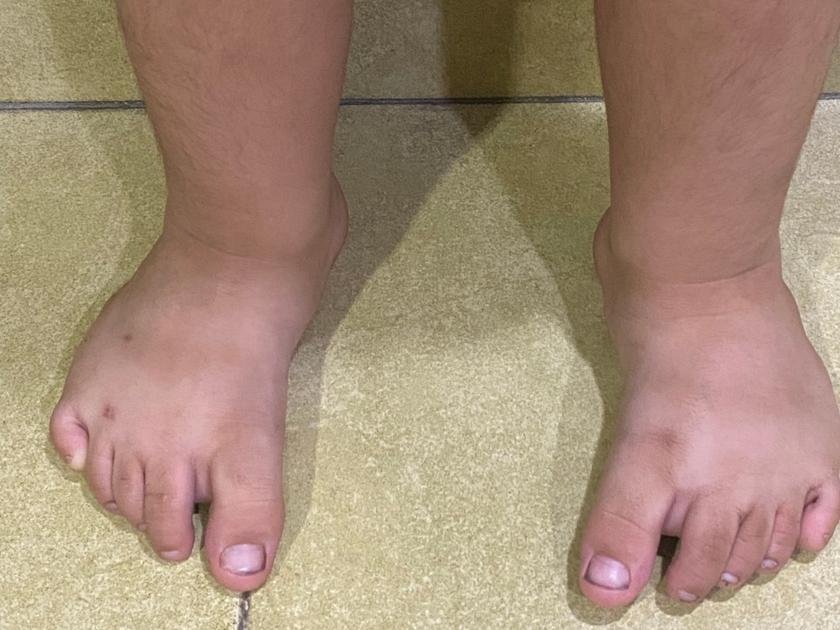 metatarsus-adductus-treatment-Hyderabad