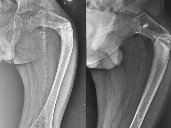 osteogeneis-imperfecta-treatment-Hyderabad