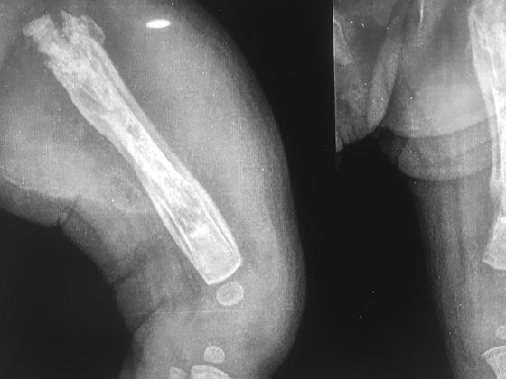osteomyelitis-septic-arthritis-treatment-Hyderabad