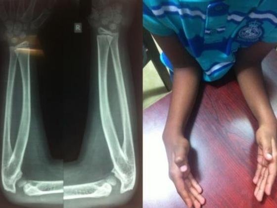 radioulnar-synostosis-treatment-Hyderabad