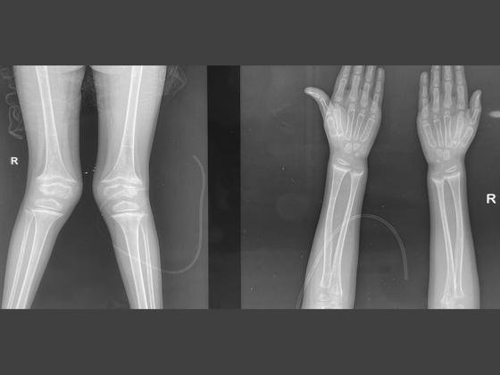 rickets-treatment-Hyderabad