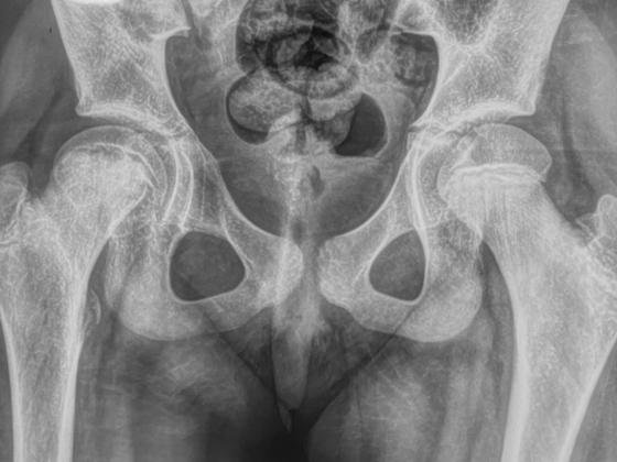 slipped-capital-femoral-epiphysis-treatment-Hyderabad