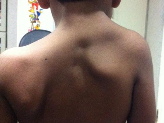 sprengel-shoulder-treatment-Hyderabad